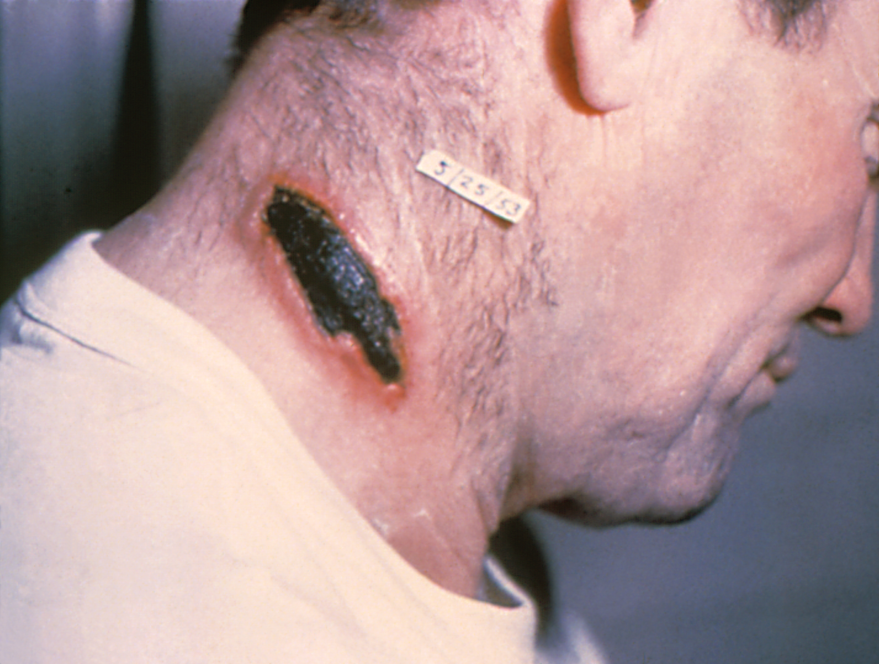 A cutaneous anthrax lesion on the neck, the classic black eschar